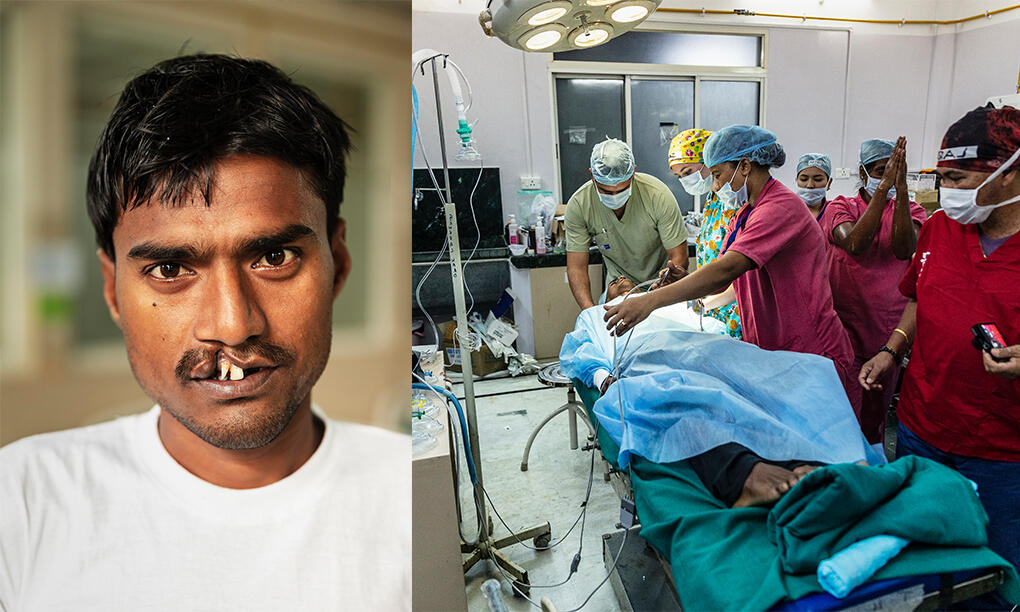 En rädsla för att aldrig bli älskad på grund av läpp- och gomspalt. Nu hoppas Tara på en bättre framtid genom Operation Smile. Foto: Jörgen Hildebranth